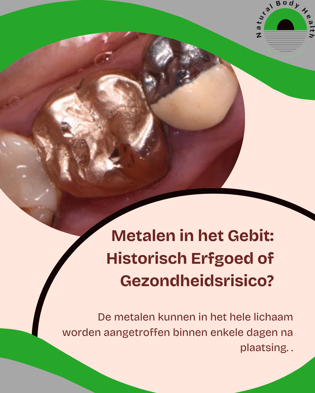 Metalen in het Gebit: Historisch Erfgoed of Gezondheidsrisico?